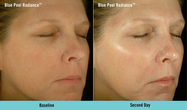Obagi Blue Peel Radiance Before And After At Body Silk Clinic