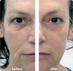 LPG Facelift Before And After - Non-invasive Treatment For Eyes And Face